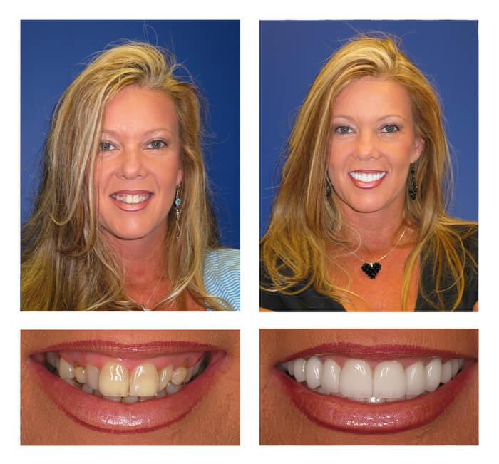 Smile Transformation 2