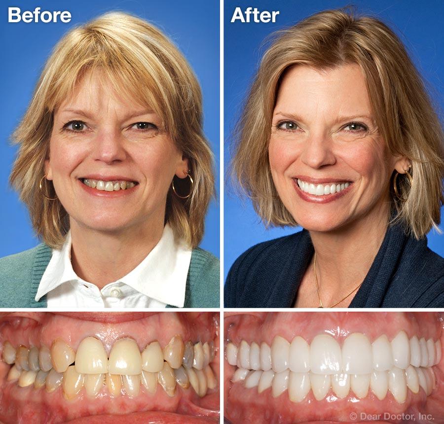 Smile Transformation 1